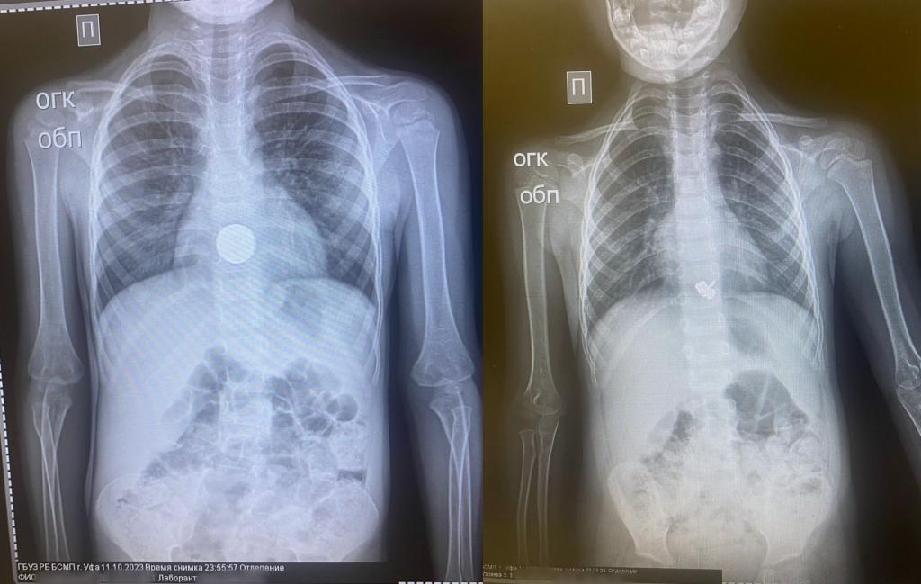 В Башкирии у детей из желудков удалили заколку и монету