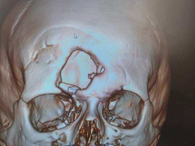 В Башкирии врачи провели краниопластику девушке, три года жившей с дырой во лбу