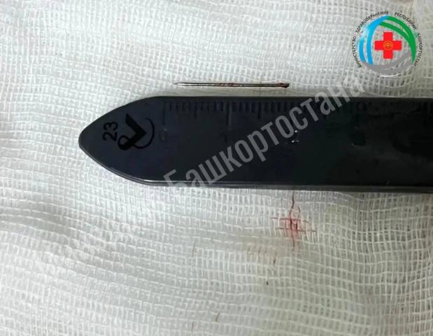 В Башкирии врачи извлекли иглу из стопы полуторагодовалого пациента В Башкирии врачи извлекли иглу из стопы полуторагодовалого пациента
