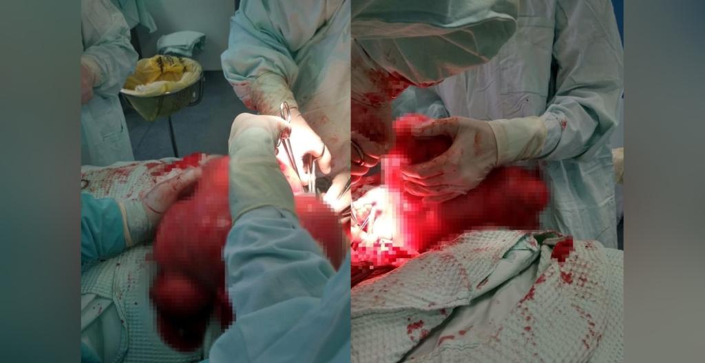 В Башкирии врачи удалили женщине 10-килограммовую миому матки